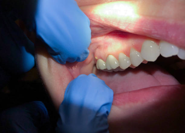 Best Broken or Chipped Tooth Repair in Bluff City, TN